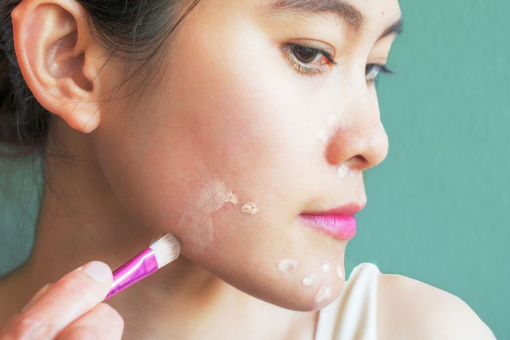 How to Cover Up a Pimple Like a Pro: Step-by-Step Guide